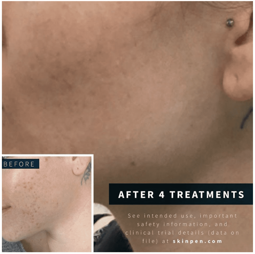 SkinPen FDA-cleared microneedling device